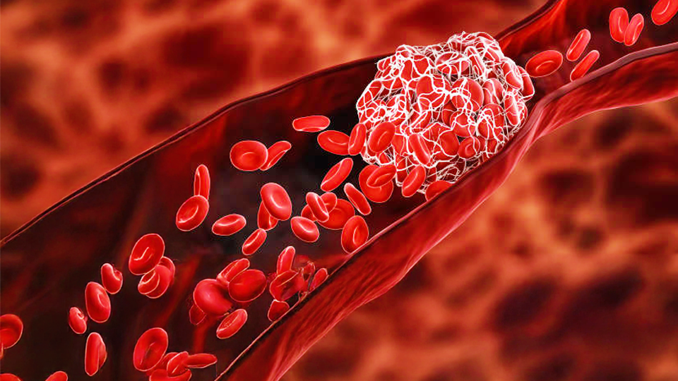 A Deep Dive into Hematology and Blood Disorders